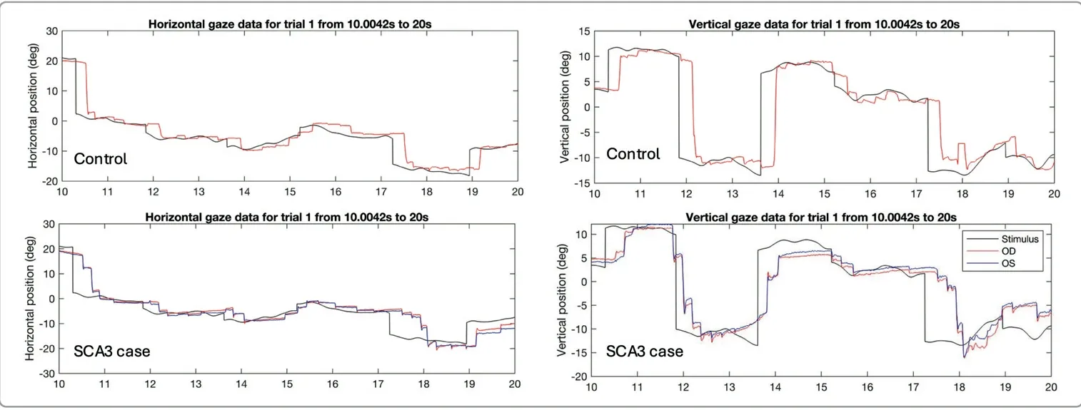 Horizontal and vertical gaze traces of a control and an SCA3 case following the SONDA stimulus, showing the case responding to each stimulus jump with several small saccades