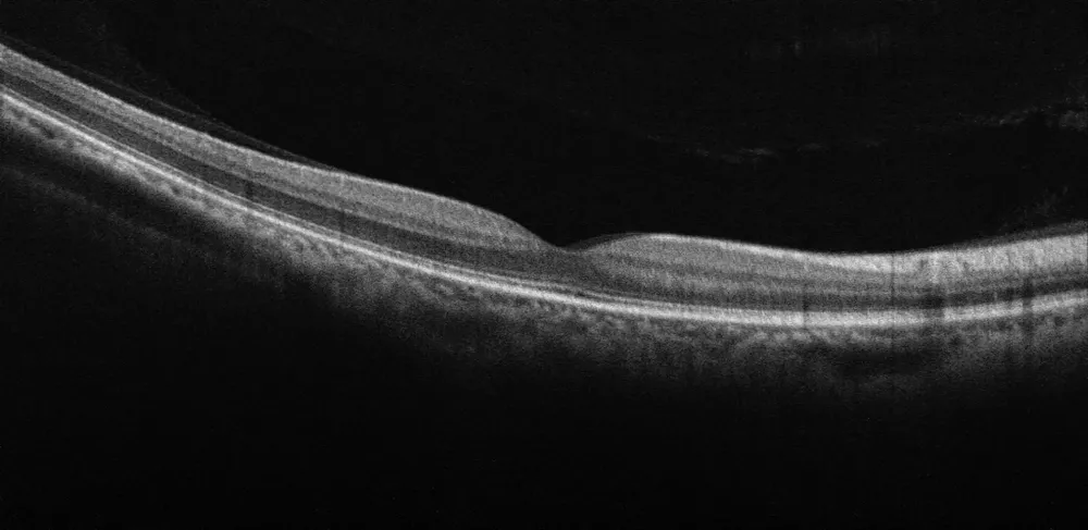 OCT cross-section of the macula showing the retinal layers and the foveal pit