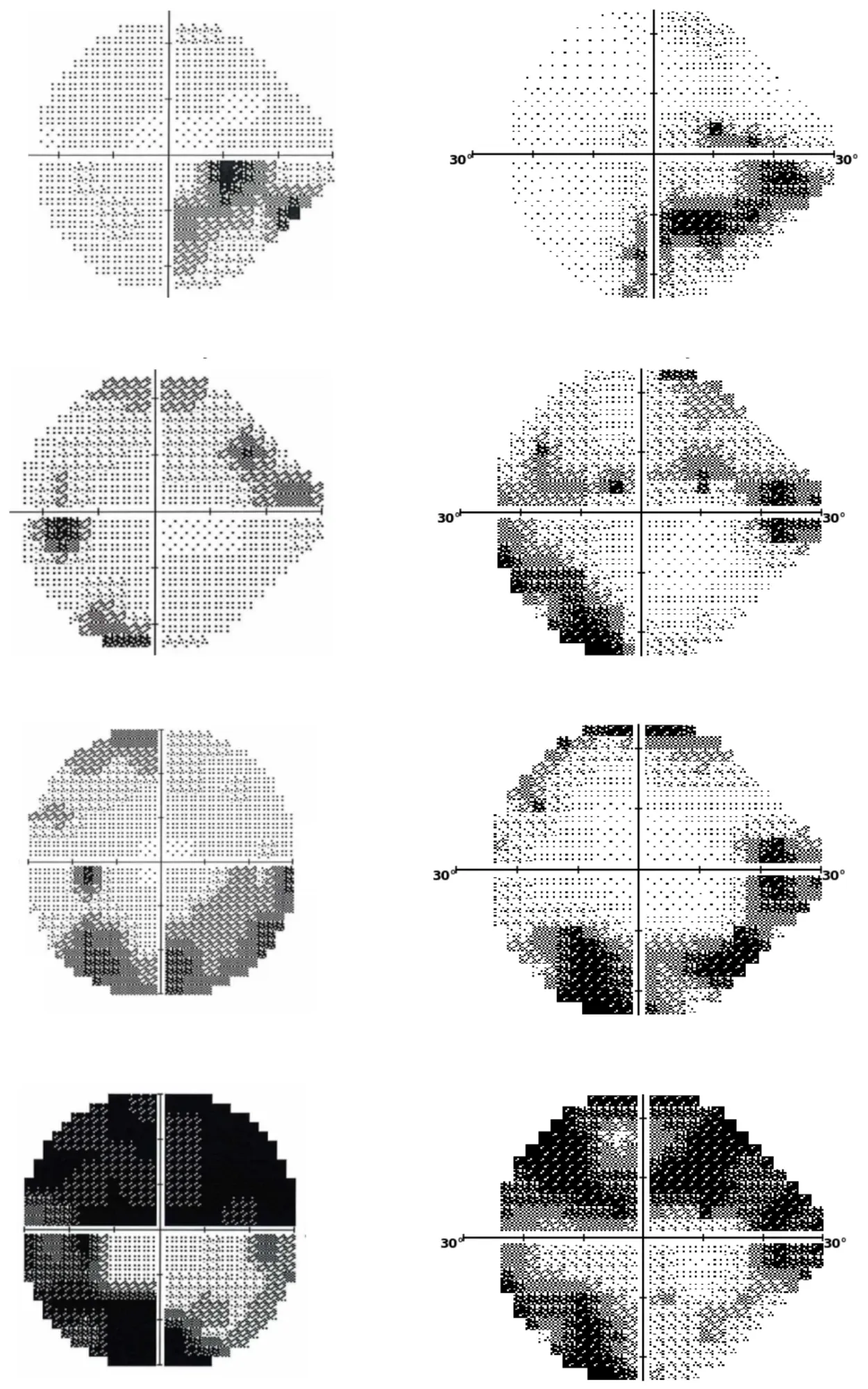 Side-by-side visual field density maps from the Humphrey Field Analyzer and SONDA for four patients of increasing glaucoma severity